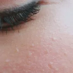 Foods You Should Avoid If You Have Hypothyroidism